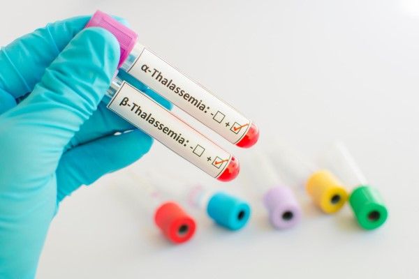 anemia - Muestra de sangre de la talasemia
