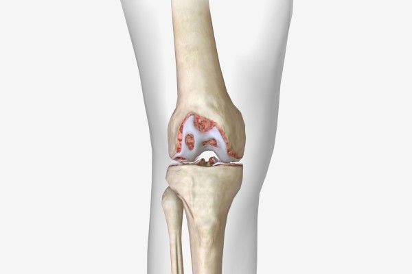 artritis - La artrosis es una forma degenerativa de artritis que afecta al cartílago articular