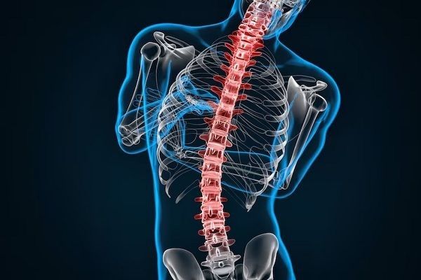 escoliosis - Dibujo de un hombre con la columna vertebral desviada