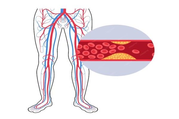 osteonecrosis - arterias obstruidas por la grasa