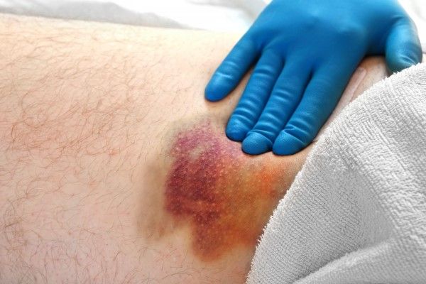 moratón en la pierna de un hombre que puede ser causado por la falta de esta vitamina