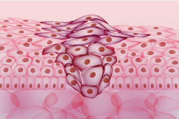 Cáncer de piel - dibujo de células cancerosas de la piel