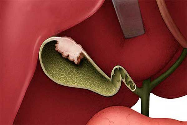 esquema del cáncer de vesícula por causa de los cálculos