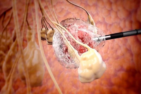 Cáncer de próstata - Dibujo en 3D del proceso para congelar el tejido prostático