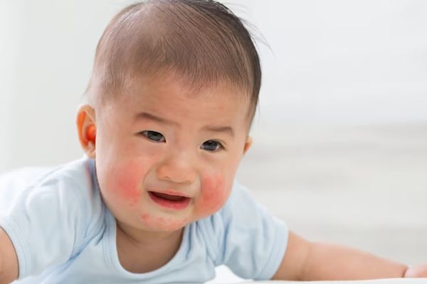 bebe asiático con indicios de problemas cutáneos en la cara