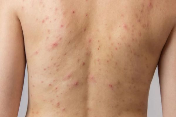 Foliculitis - joven blanco con un problema de foliculitis superficial por toda la espalda