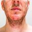 foliculitis - hombre blanco con folículos pilosos de la barba infectados por estafilococos