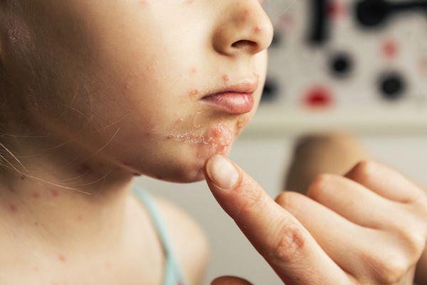 Impétigo - niña con ampollas alrededor de la boca por un impétigo ampolloso