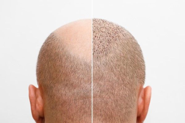resultados del trasplante capilar - La cabeza de un hombre calvo antes y después de la cirugía de trasplante de cabello