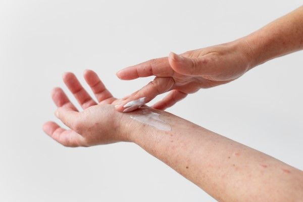 Rubéola - mujer aplicándose una crema en la piel para tratar unas erupciones en la piel