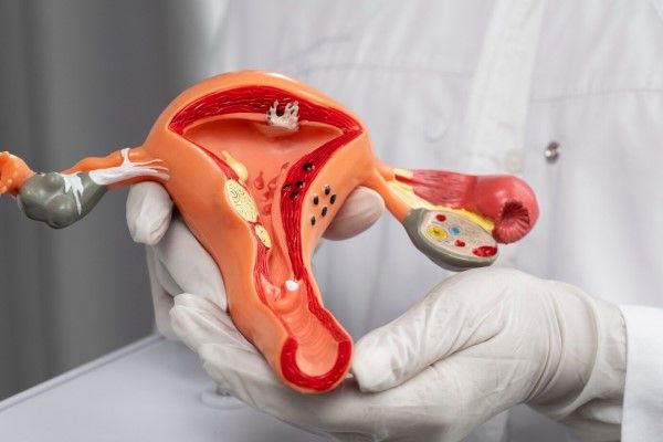 doctor sujetando un modelo anatómico del órgano reproductor femenino