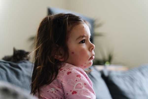 Varicela - niña blanca con el pelo castaño con un pijama rosa en el sofá de su casa con varicela