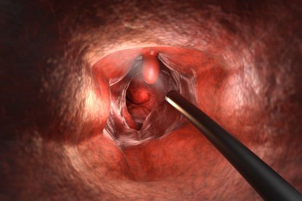Cáncer de colon - vista de un pólipo posiblemente canceroso durante una colonoscopia