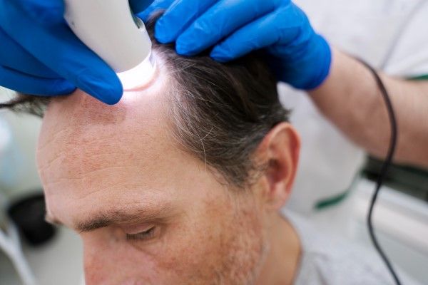 trasplante capilar sin rapar - hombre en la consulta del tricólogo comprobando si puede someterse a un trasplante capilar sin rapar