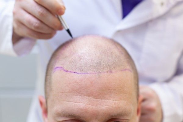 Evolución del trasplante capilar - Médico tricólogo realizando el diseño del trasplante capilar Madrid a un hombre con alopecia androgénica