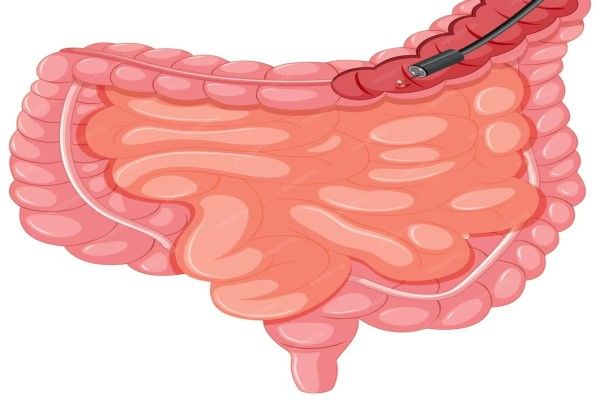 Cáncer de colon - toma de muestras de tejido durante una colonoscopia