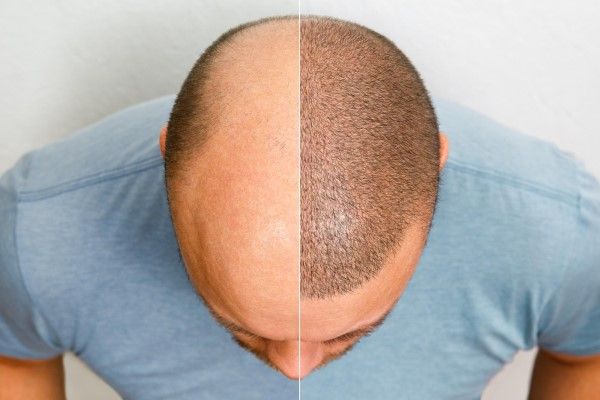 imagen del antes y después de un injerto capilar en un hombre