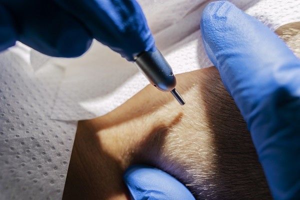 tricólogo recogiendo unidades foliculares de la zona donante para la técnica FUE