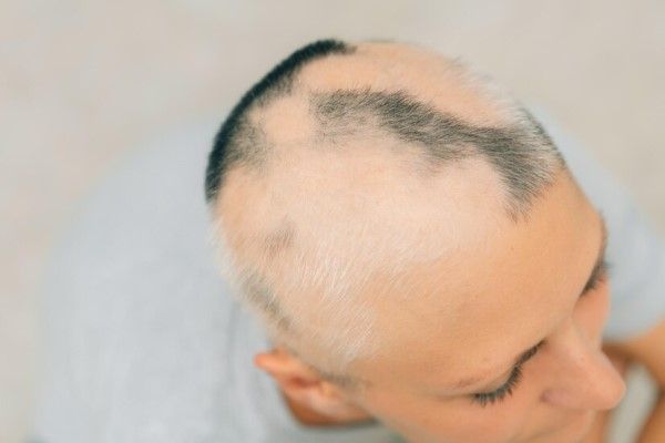 Alopecia areata real en una mujer joven