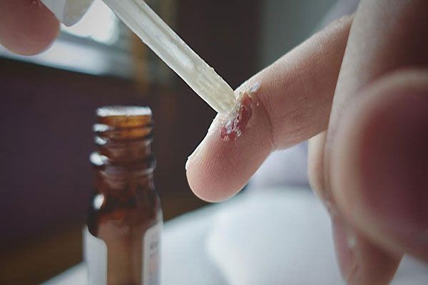 Verrugas comunes - Persona con anomalías en los dedos aplica ácido salicílico para eliminar una verruga