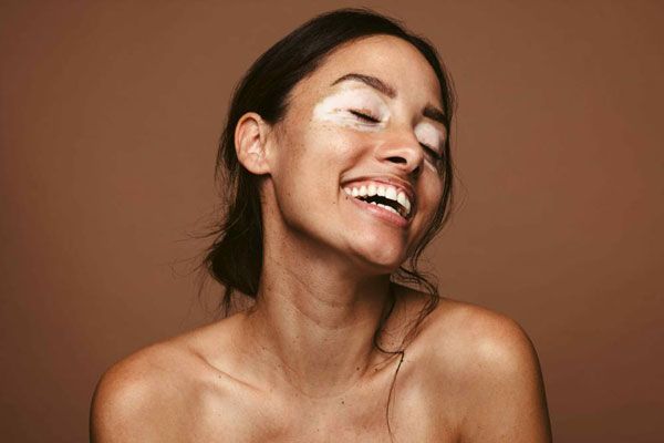 Vitíligo - Mujer con vitíligo en alrededor de los ojos muestra una amplia y genuina sonrisa frente a la cámara 