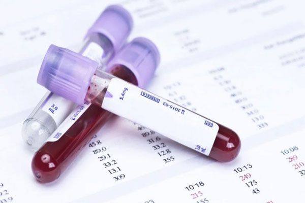 Enfermedad de Alzheimer - Tubos de ensayo con sangre como parte de las muestras de unos análisis de rigor