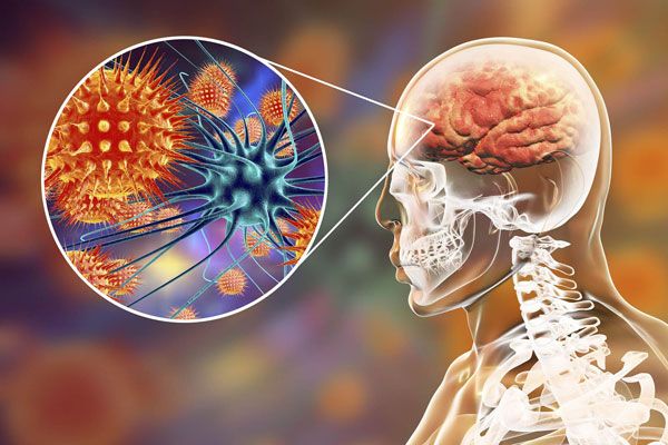 Meningitis bacteriana - Vista ampliada y microscópica de una serie de bacteria que se han colado en el cerebro
