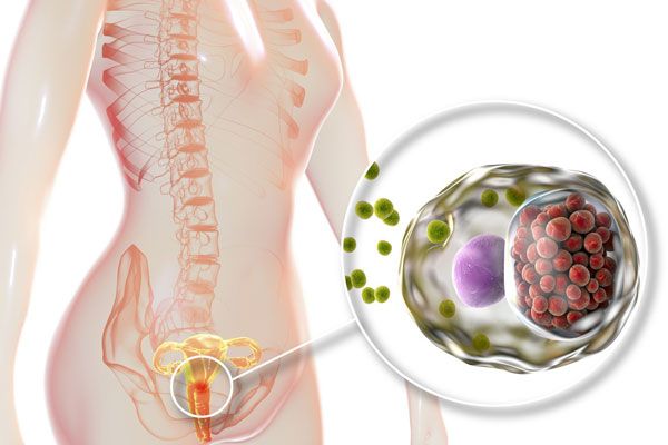 Clamidia - Ilustración de la bacteria de la clamidia presente en los genitales femeninos 