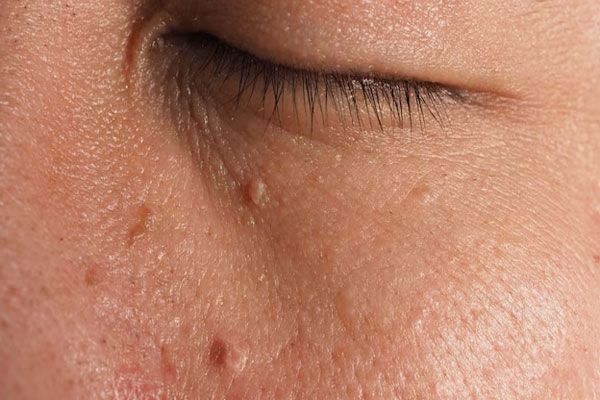 Verrugas comunes - Vista ampliada de un hombre con verrugas alrededor del contorno de sus ojos 