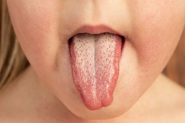 Escarlatina - Niña con lengua blanca como parte de los síntomas más característicos de una infección bacteriana 