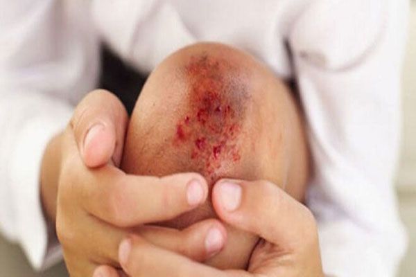 Hemofilia - Niño con raspón en la rodilla presenta un sangrado excesivo como parte de un trastorno de coagulación 