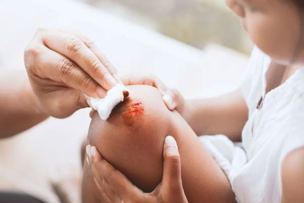 Hemofilia - Madre asiste a su hija con un algodón tras romperse la rodilla 