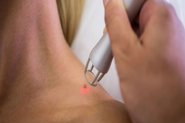 Mujer se somete a tratamiento láser especializado para eliminar una lesión pigmentaria
