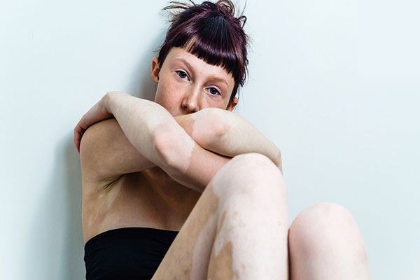 Mujer con enfermedad de la piel extendida se cruza de brazos para ocular parte de sus cambios 