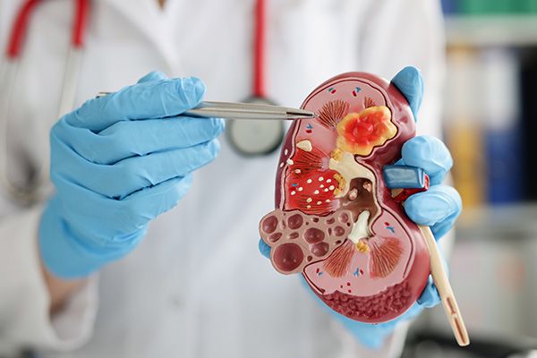 Diabetes - Doctora explica las importantes funciones que cumplen los riñones en el organismo 