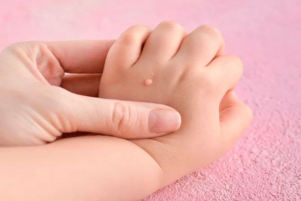Verrugas comunes - Madre sostiene la mano de un niño infectado con el virus del papiloma humano 