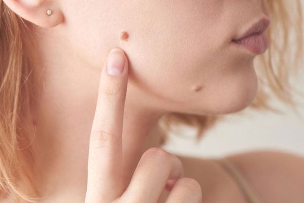 Joven señala con su dedo la prominencia de uno de sus lunares más destacados en el rostro 