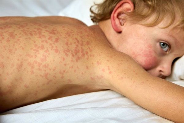 Escarlatina - Niño acostado boca abajo en la cama con sarpullido inusual en toda la extensión de la espalda y en parte de la cara 