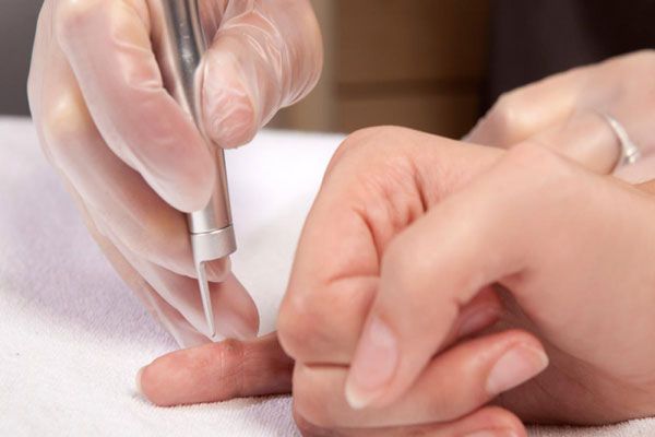 Verrugas comunes - Tratamiento especializado para eliminar protuberancias de piel en el extremo de los dedos 