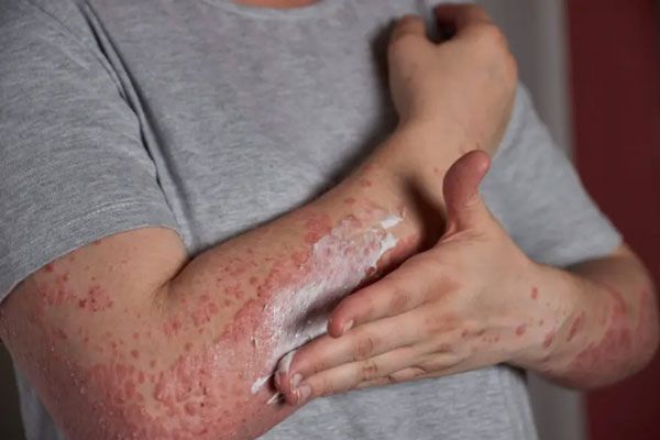 Hombre aplica una loción sobre sobre la piel para aliviar la comezón de una enfermedad infecciosa 