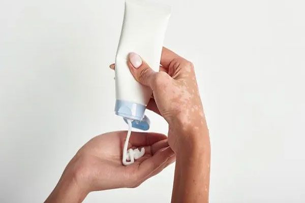 Vitíligo - Ungüento especial para atenuar o retrasar la aparición de manchas en la superficie cutánea 