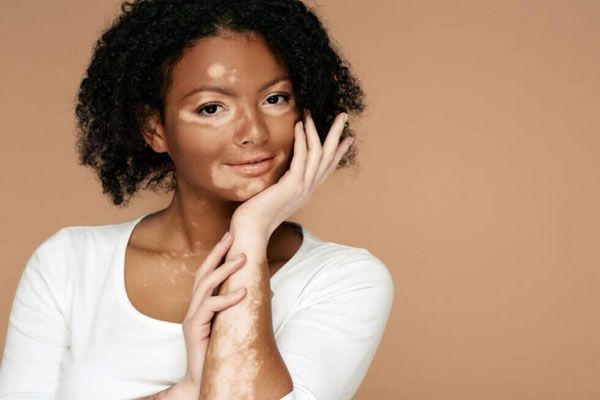 Vitíligo - Mujer morena y de cabello rizado con enfermedad de la piel en un estado relativamente avanzado 