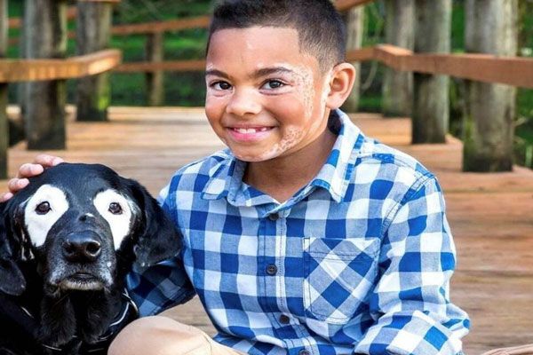 Vitíligo - Niño con manchas en el rostro posa y sonríe orgulloso junto a su perro 