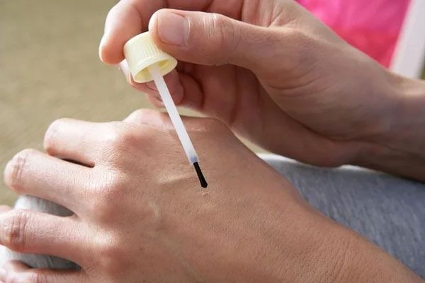 Verrugas comunes - Hombre usa una minibrocha con ácido tricloroacético para remover bultos de piel endurecidos 