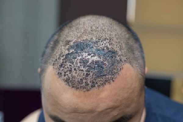 postoperatorio del trasplante capilar - Imagen de las costras de la cicatrización de los injertos de un trasplante capialr