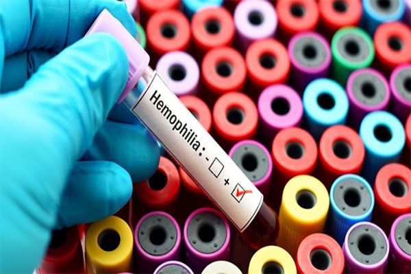 Hemofilia - Muestra de análisis de sangre en laboratorio da positivo a hemofilia 