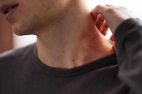 hombre con un fuerte enrojecimiento de la parte del cuello
