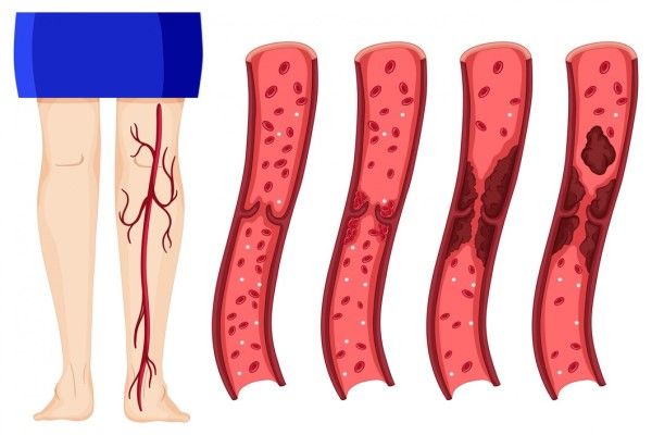 Flebitis - dibujo de como se forman los coágulos en las venas
