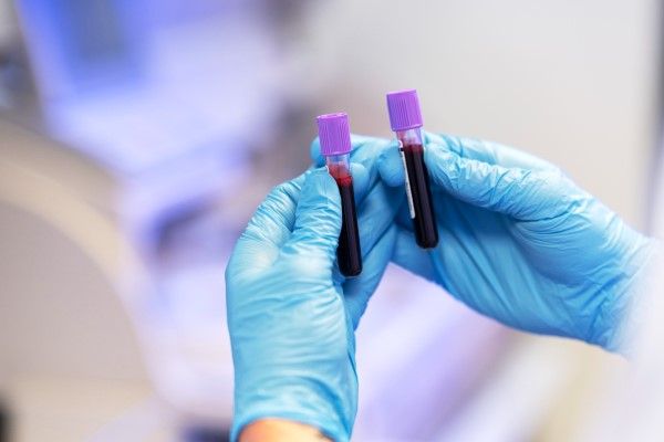 Flebitis - técnico de laboratorio con dos muestras de sangre para su análisis