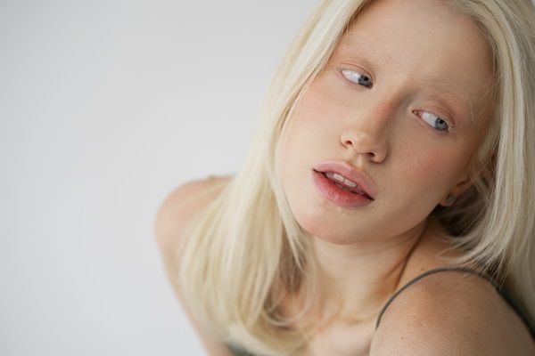 Albinismo - Mujer albina de cabello rubio y ojos claros mirando hacia un costado